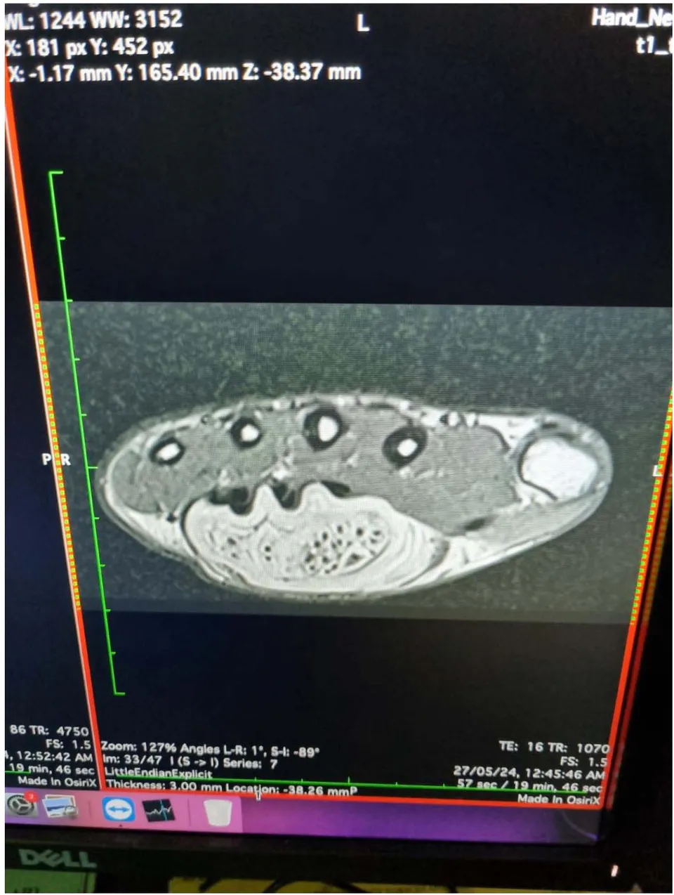 Figure 8: Magnetic Resonance imaging of Lipofibromatous Hamartoma with coaxial cable-like appearance