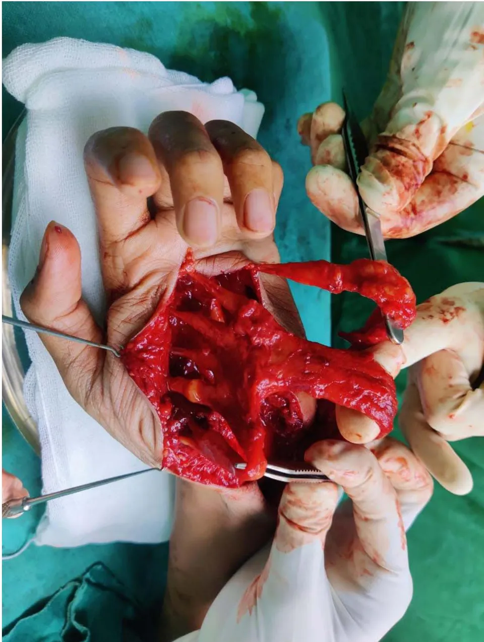 Figure 6: Intraoperative image of the Lipofibromatous Hamartoma in the common and proper digital nerves of the left thumb, index and middle finger