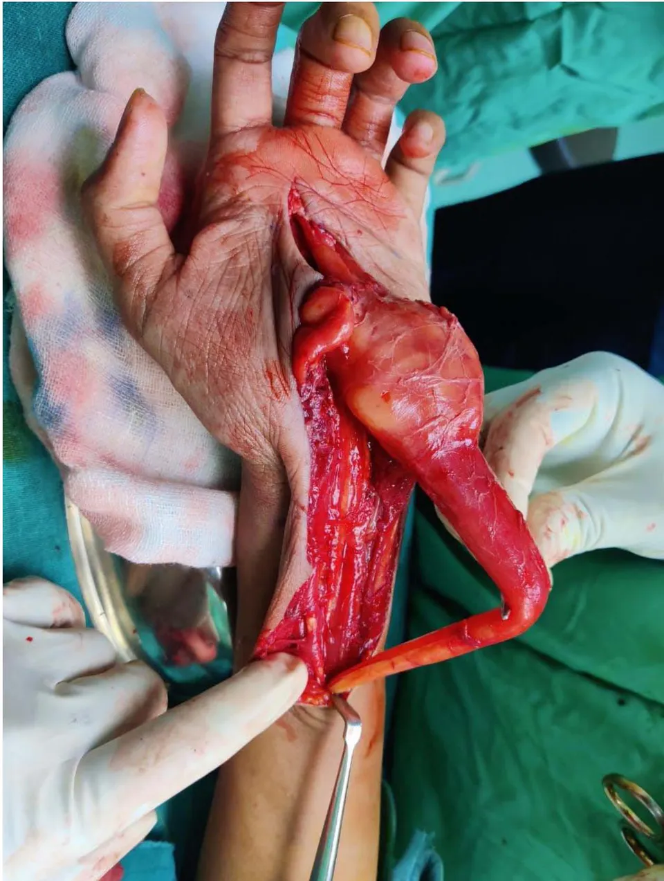 Figure 5: Intraoperative image of the Lipofibromatous Hamartoma continuous with the Left hand median nerve