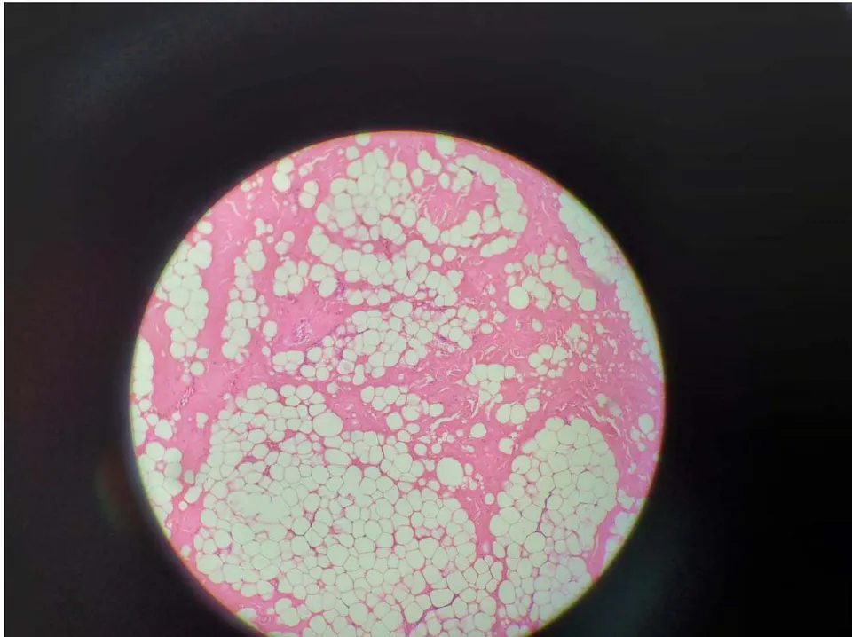 Figure 7: Histopathology of Lipofibromatous Hamartoma with extensive hyalinised collagen bundles in which single fibroblasts are randomly scattered. (H&E stain, magnification x40)