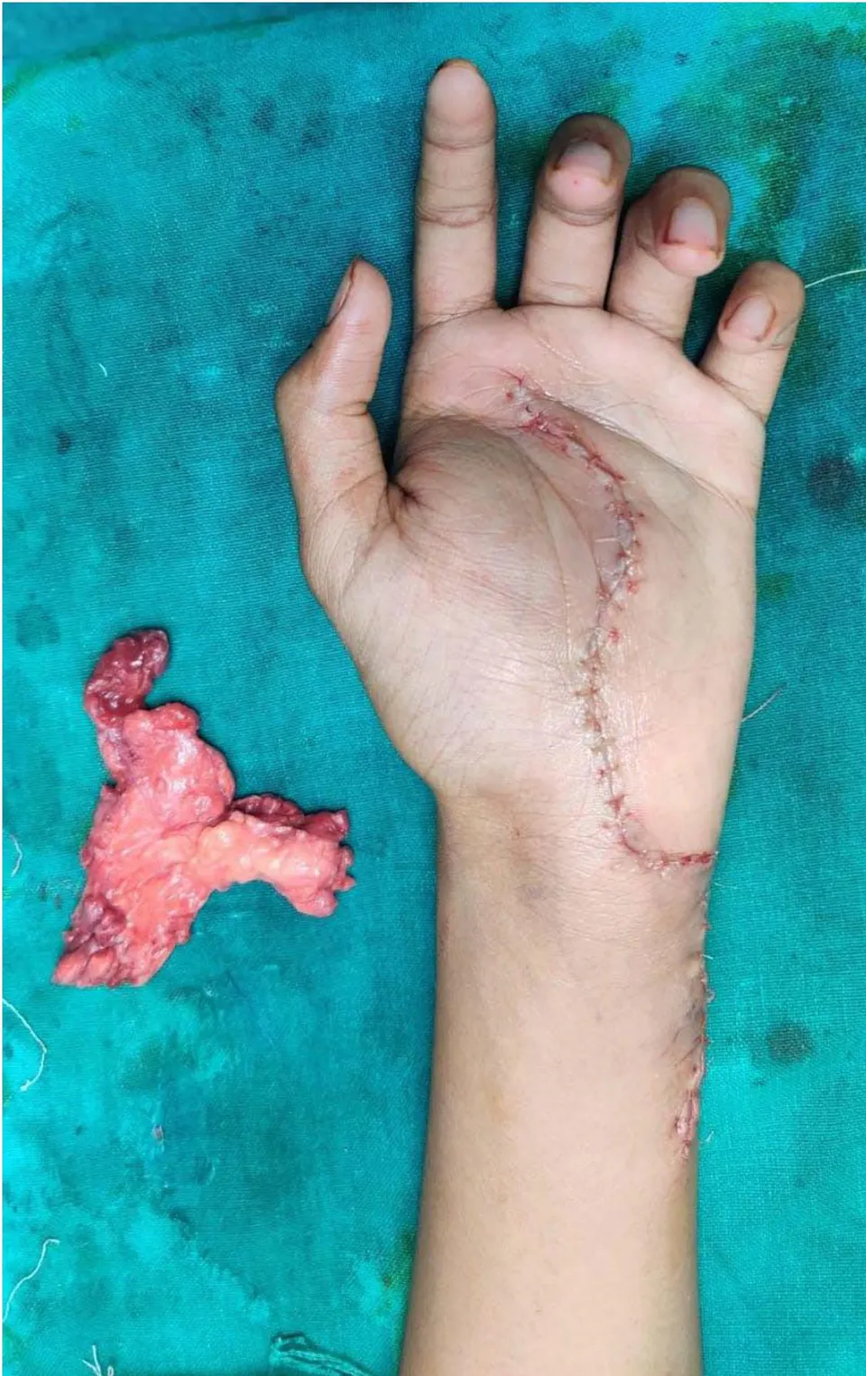 Figure 2: Postoperative image showing excised specimen with the suture line