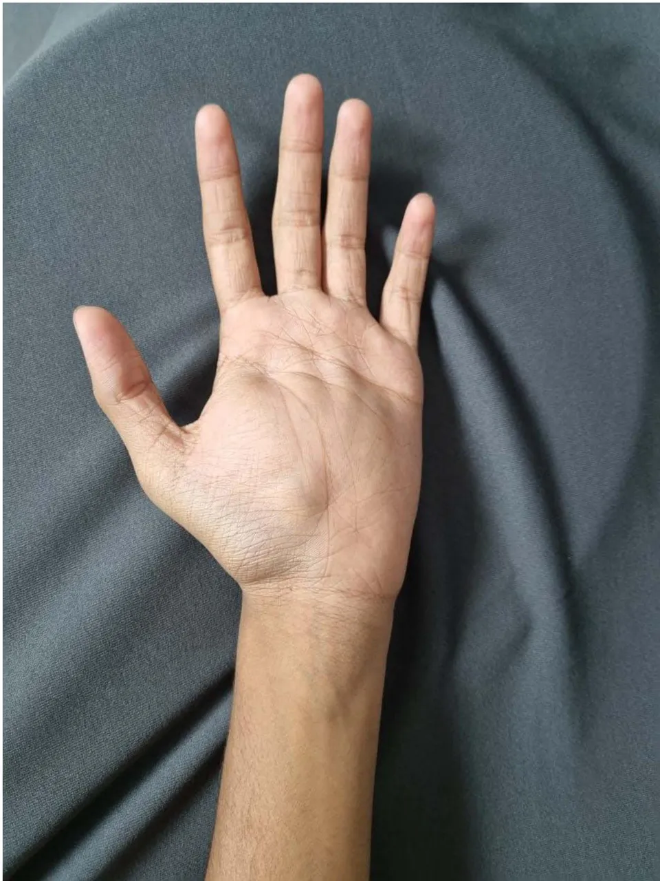 Figure 1: Preoperative image showing Left Hand palmar aspect swelling