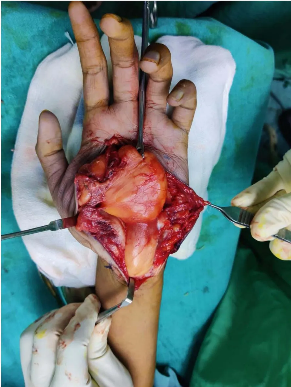Figure 4: Intraoperative image of the Lipofibromatous Hamartoma in the palm of Left hand