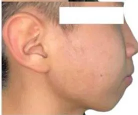 Figure 1: Pre-Treatment Extraoral Photographs