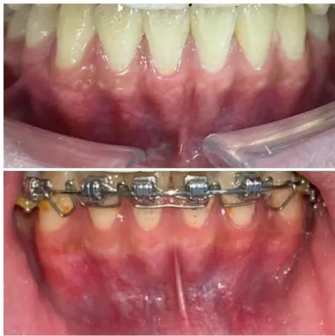 Figure 7: Torque control of the mandibular incisor roots using an ART torque spring during space closure