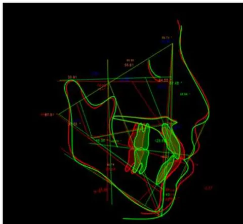 Figure 14: Post-treatment Ricketts Cephalometric Analysis Figure 15: Superimposition on Ba-N at CC after treatment