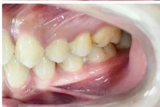 Figure 2: Pre-Treatment Intraoral Photographs
