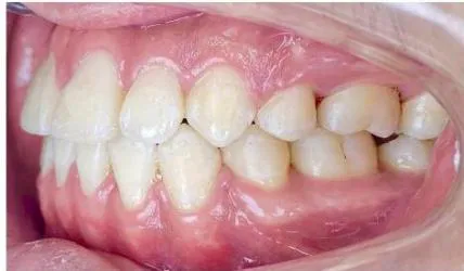 Figure 10: Post-treatment intraoral photographs