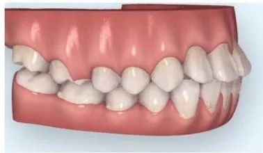 Figure 3: Pre-Treatment Intraoral 3D Digital Models