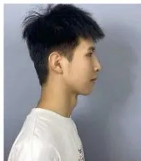 Figure 11: Comparison of incisor root position before and after treatment