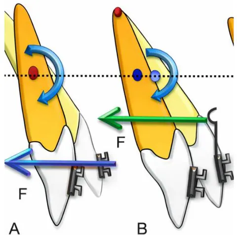 Figure 16: Negative torque moments and tooth extrusion occurring during space closure with force application below the center of resistance