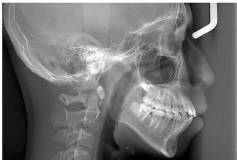 Figure 4: Pre-Treatment Lateral Cephalometric Radiograph