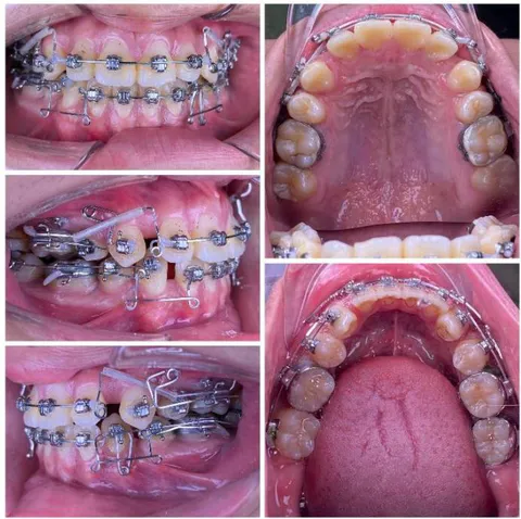 Figure 8: Space closure performed by segmented loop mechanics for canine retraction, followed by anterior space closure using a retraction arch with three-dimensional torque control