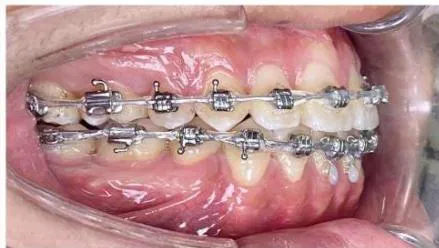 Figure 9: Re-leveling and alignment phase following anterior space closure of the four incisors
