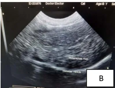 Figure 2: Hypoechoic foci on liver parenchyma (cyst or tumor) (A); Hyper echoic foci (necrosis or fibrosis tissue) and thickened liver capsule (B)