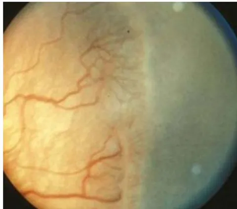 Fig. 1: Shows stage 3+ ROP