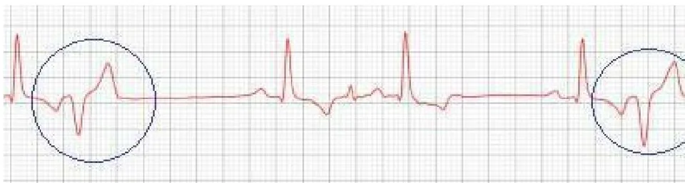 Figure 4: Electrocardiographic tracing (2022): showing episodes of premature ventricular complex (circles)