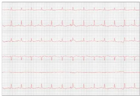 Figure 8: Reevaluation of the electrocardiogram (September/2023)