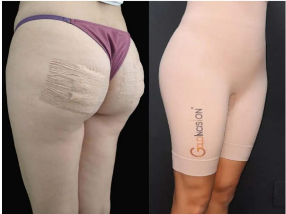 Figure 3: Compression dressing on the undermined areas and compression garment. Source: Own figure.