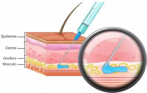 Figure 1: Sectioning of the septa with the Goldincision technique. Source: https://goldincision.com.br/tratamento-celulite-subcisao-preenchimento/ Figure 2: Application of collagen biostimulant with PMMA using the Goldincision technique. Source: https://goldincision.com.br/tratamento-celulite-subcisao-preenchimento/