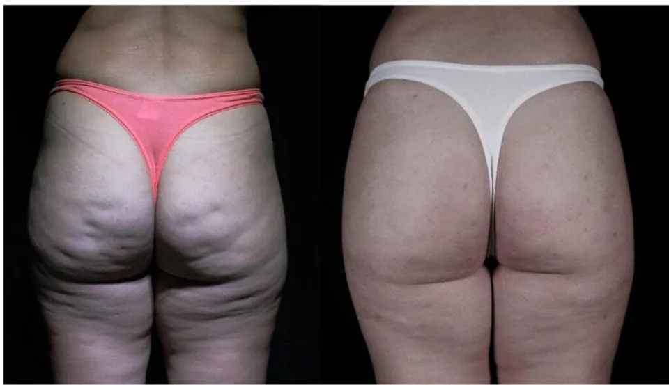 Figure 11: Patient, 43 years old, submitted to 1 session of Goldincision treatment. 45ml of PMMA was used to biostimulate the region and the fibroussepta were sectioned. First photo taken before the procedure and the second photo taken after 71 days. Source: Own figure.