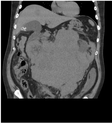 Figure 2: Coronal slice of the abdomen noting same mass with significant displacement of the bowels. A hypodense lesion can be visualised on the liver
