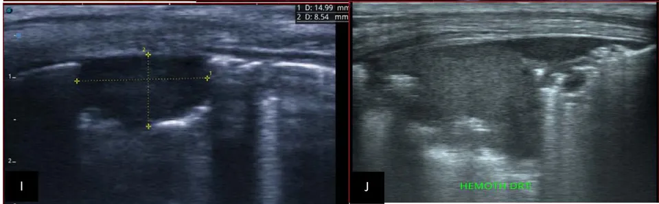 Figure 8: Patient aged 6 years, referred for abdominal bloating, in whom we noted: Image A: illustrates a right endo and exo renal solid mass, in B mode, heterogeneous, interspersed with hypo, iso and hyperechoic areas.