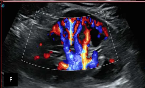 Figure 7: 7-year-old patient with normal renal Doppler ultrasound examination: Images A and B: normal morphology of the right kidney in B-mode; Image C: normal vascularization of the right kidney in color Doppler mode. Images C and D: represent a normal morphology of the left kidney in B mode. Image F: represents normal vascularization of the left kidney in color Doppler mode. Source: Dr. Frederick Tshibasu Tshienda database.