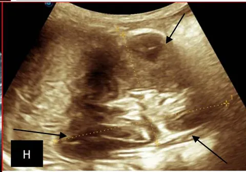 Figure 5: Abdominopelvic ultrasound control after 6 courses of chemotherapy in the same 3 year old patient with a ruptured left renal nephroblastoma; Images A, F, G, and H: show regression of the solid, endo and exo renal, left nephroblastoma mass treated with 6 courses of chemotherapy (current volume 430 ml vs) Images: B, C, and: show persistence of thrombotic permeation pan vena cava and ipsilateral renal. Image E: shows a volumetric regression of the intra-lesional hematic collection, at the tumor rupture estimated at 34.49 ml VS, Image I: represents the right kidney in B mode which is of normal echoculture. Source: Dr. Frederick Tshibasu Tshienda database.