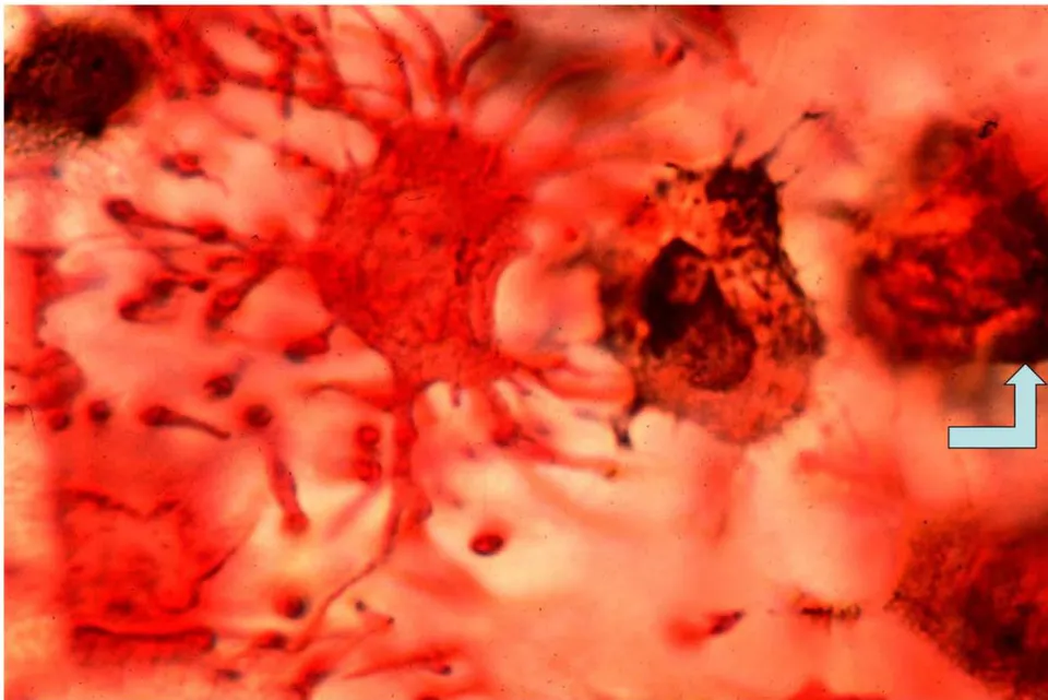 Figure 7: Three osteocytes in intact developing mouse calvarium sequentially loading with bone mineral in a cycle of approximately fifteen minutes. Left cell: loaded throughout with red-stained calcium. Middle cell: brown-stained phosphate released from the nucleus into the cytoplasm. Right cell: densely packed mineral particulates fabricated in the expanded, crescent-shaped juxtanuclear golgi apparatus (arrowed). GBHA and von Kossa stain, Nomarski optics [38].