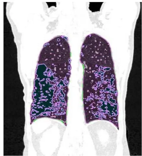 Figure 1: Visual representation of emphysema (blue), normal tissue (pink), and fibrosis (green)