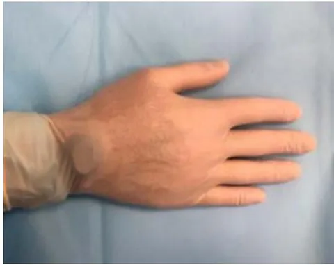 Figure 3: Individual dosimeter fixed in the area of the wrist joint