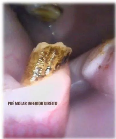 Fig. 6: Ponta dentária em pré molar inferior esquerdo (seta vermelha). Vista rostral intraoral.