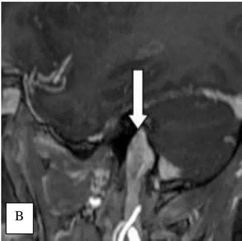 Figure 6: Sagittal reconstruction of MPR T1 gadolinium showing a thrombus in the sigmoid sinus (arrow). Sagittal thin MIP reconstruction on B showing no obvious thrombus (arrow) "drowned" by the summation of hyperintense pixels.