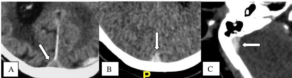 Figure 4: Showing a normal appearance of the sagittal superior sinuse without injection (arrow A) and after injection (arrow B and C)