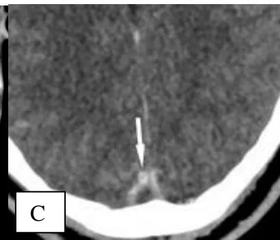 Figure 3: Spontaneous Hyperattenuating sign on the left lateral sinuse (arrow) compared with the right normal side (arrowhead). An injected CT axial section showing a empty delta sign with relatively hypodense central thrombus and enhanced triangular walls arrow B and C.