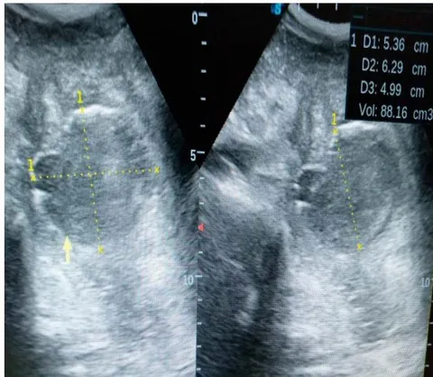 Figure 1: An ultrasonogram of the right iliac fossa region following the use of a 3.5MHz probe transducer showing a near oval area with slight irregularity of the superior walls having a heterogeneous collection with a volume of about 88mls and surrounding hypoechoic fluid; inflammatory and surrounding sentinel loops; focal paralytic ileus. This is the deep seated appendiceal abscess with surrounding focalileus.